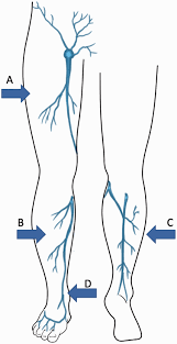 Schema anatomico delle aree standardizzate per l'ecografia nel lipedema (A pretibiale, B laterale gamba, C coscia anteriore, D sovramalleolare mediale)